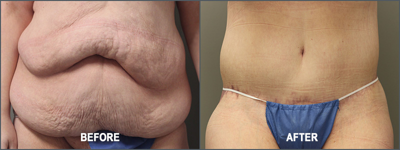Before & After Image Gallery - Female Belt Lipectomy Surgery - USculpt  Plastic Surgery - Toronto