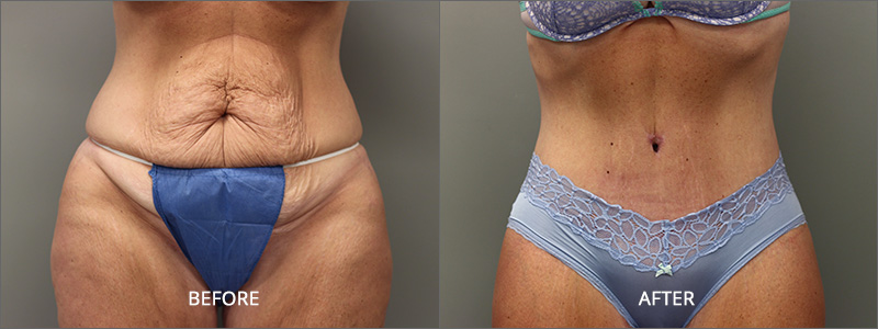 Before & After Image Gallery - Female Belt Lipectomy Surgery - USculpt  Plastic Surgery - Toronto