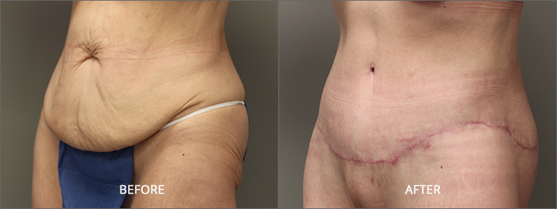 Before & After Image Gallery - Female Belt Lipectomy Surgery