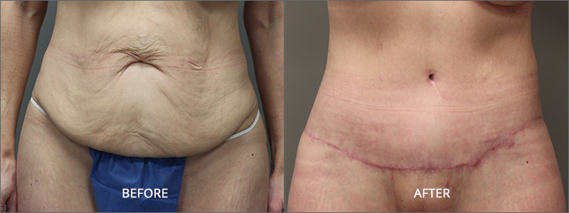 Belt Lipectomy in San Francisco Before & After - Body Lift