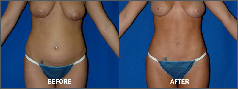 Smart Liposuction Photo Gallery - Belred Cosmetic Surgery