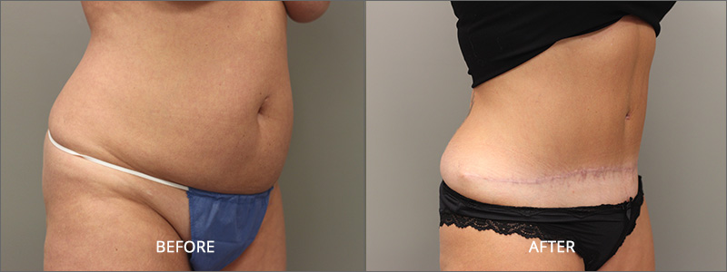 Before & After Image Gallery - Tummy Tuck Surgery - USculpt Plastic Surgery  - Toronto